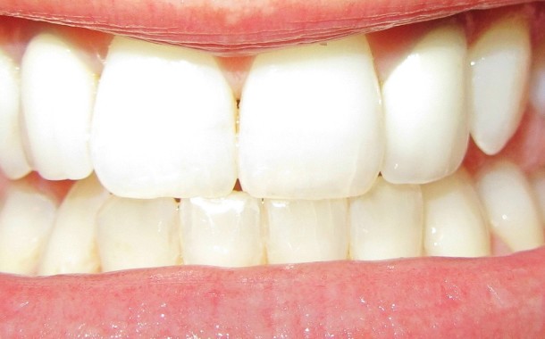 Ordem dos Médicos Dentista aplaude suspensão da publicidade ‘Portugal a Sorrir’