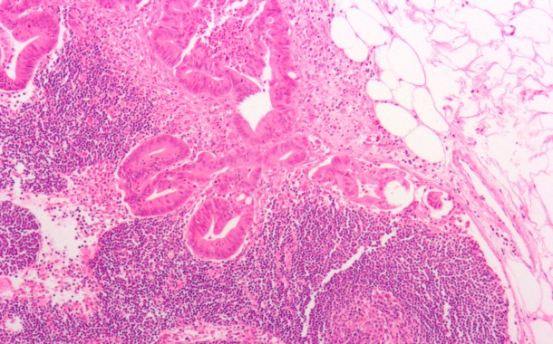 Investigadora da UMinho desenvolve estudo que “induz morte em células de cancro colorretal”