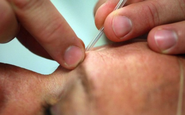 Acupunctura ajuda a combater disfunção eréctil, diz especialista português