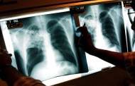 Tuberculoso diminui no Norte mas Barcelos e Esposende continuam zonas de risco