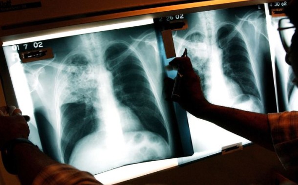 Tuberculoso diminui no Norte mas Barcelos e Esposende continuam zonas de risco
