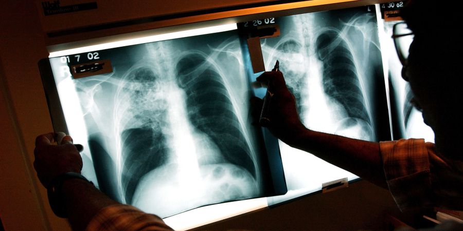 Tuberculoso diminui no Norte mas Barcelos e Esposende continuam zonas de risco