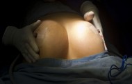 Fraude dos implantes mamários: Portugal detectou ruptura de próteses PIP em 67 mulheres