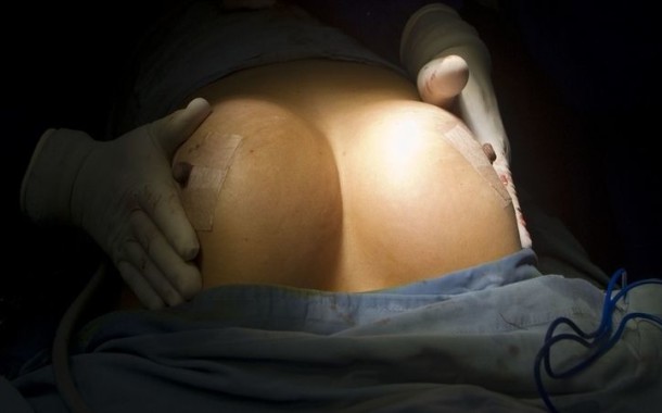 Fraude dos implantes mamários: Portugal detectou ruptura de próteses PIP em 67 mulheres