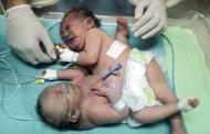 Siamesas de Gaza que corriam risco de vida foram separadas com sucesso