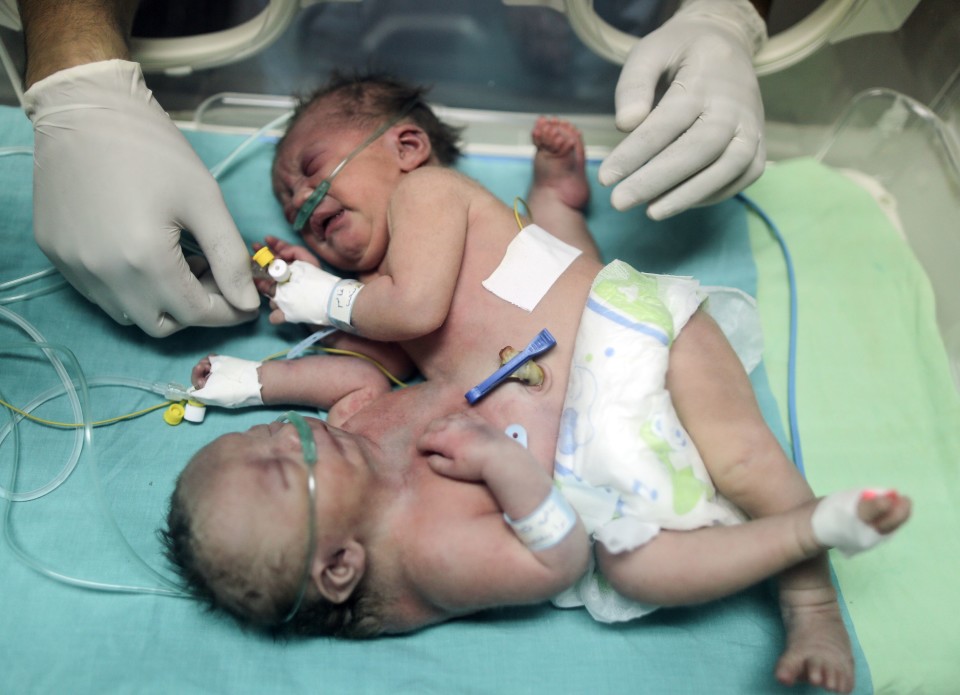 Siamesas de Gaza que corriam risco de vida foram separadas com sucesso