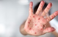 Casos suspeitos de sarampo no Norte do país aumentam para 34