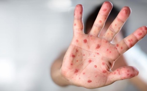 Casos suspeitos de sarampo no Norte do país aumentam para 34