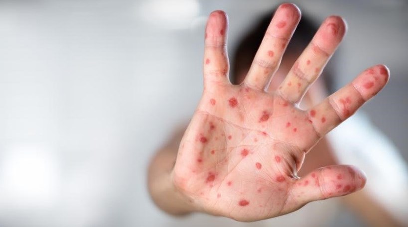 Casos suspeitos de sarampo no Norte do país aumentam para 34