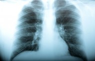 Portugal é o país europeu onde mais se morre de pneumonia