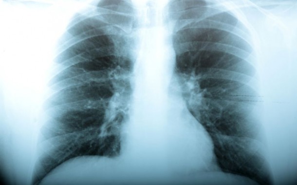 Portugal é o país europeu onde mais se morre de pneumonia