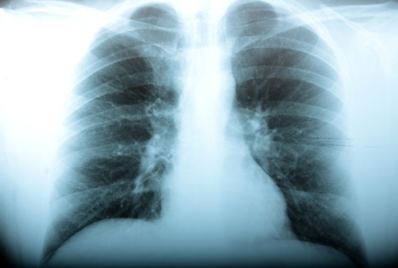 Portugal é o país europeu onde mais se morre de pneumonia