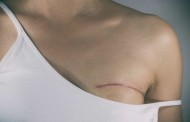 Cancro da mama mata quatro portuguesas por dia