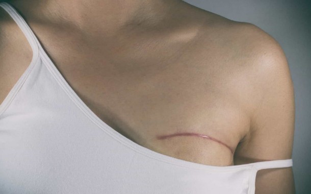 Cancro da mama mata quatro portuguesas por dia