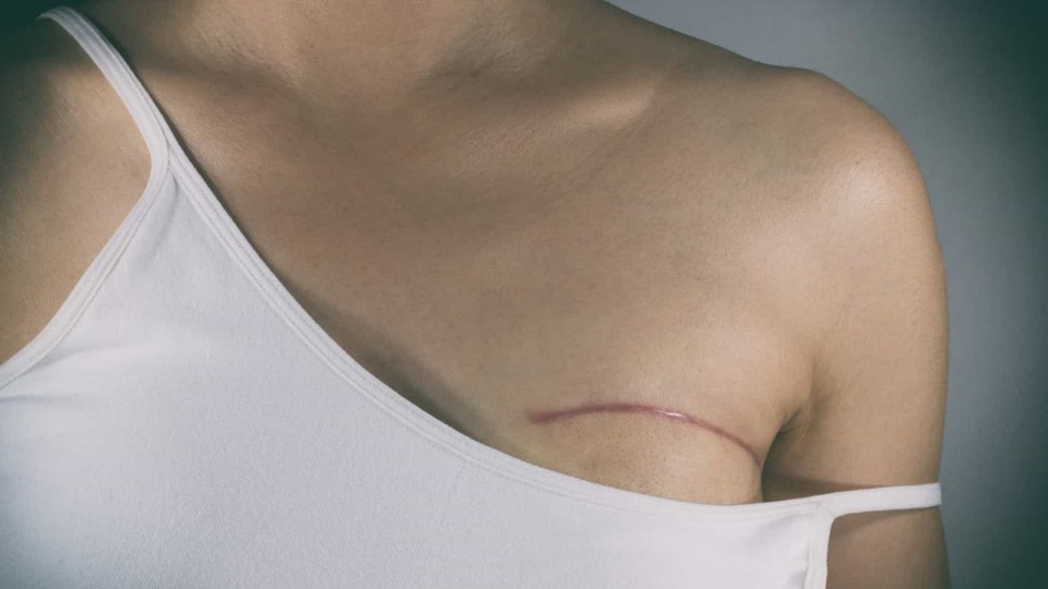 Cancro da mama mata quatro portuguesas por dia