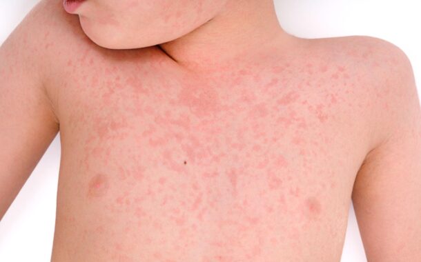 OMS alerta sobre aumento significativo de casos de sarampo no mundo