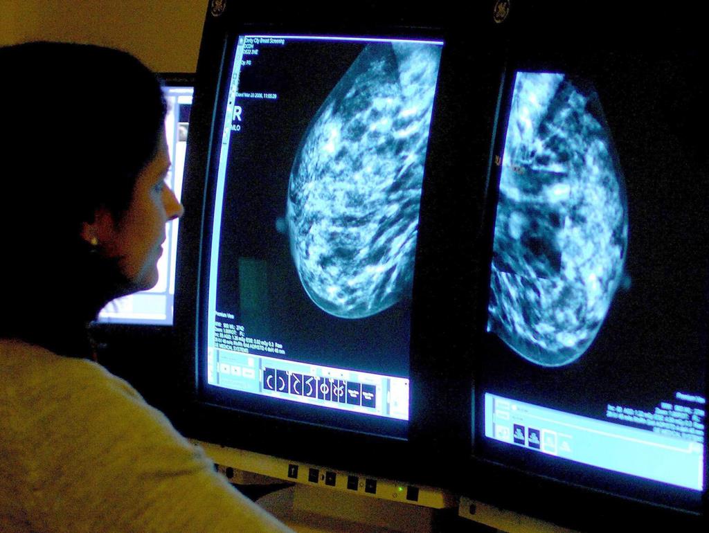 Governo reduz idade do rastreio do cancro da mama para 45 anos